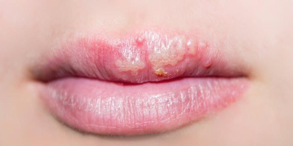 اسباب الحساسية حول الفم