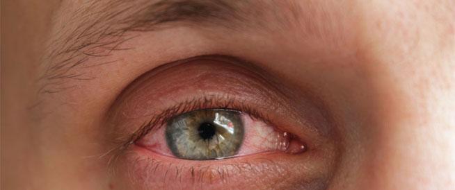 ما هو أكثر أمراض العيون انتشاراً