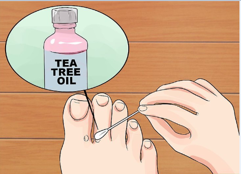 علاج عين السمكة