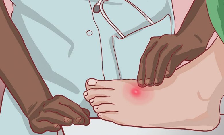 تجربتي في علاج الدمل