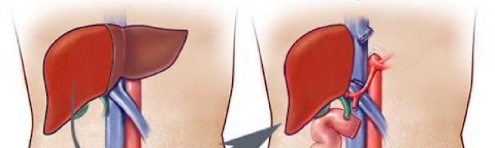 تجربتي مع زراعة الكبد تجربتي مع زراعة الكبد