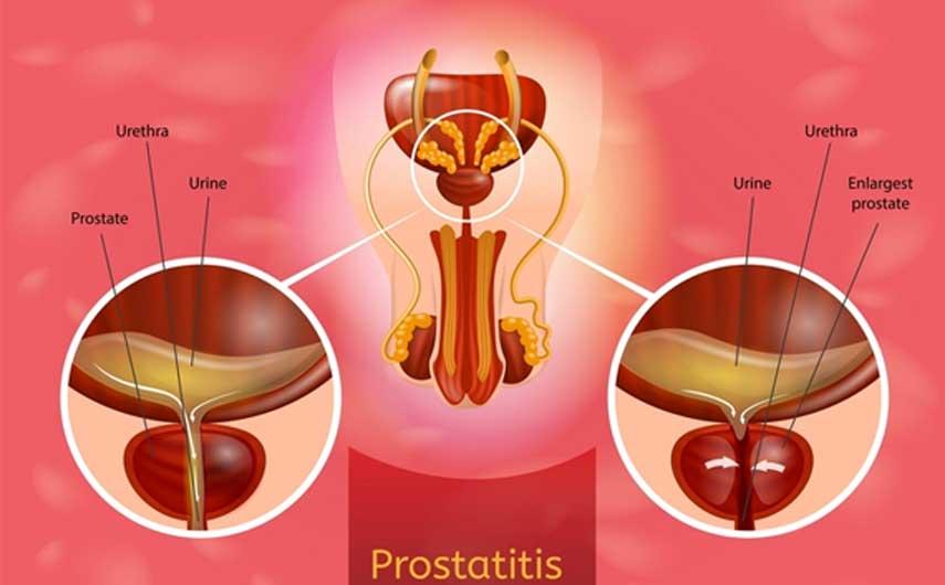 أعراض إلتهاب البروستاتا