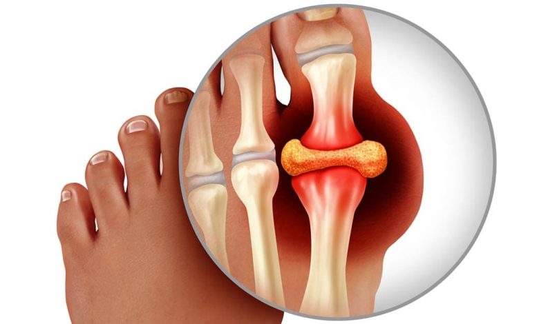 علاج النقرس السريع