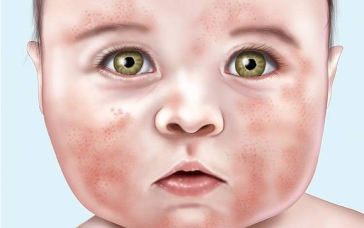 طرق علاج القوباء الجلدية