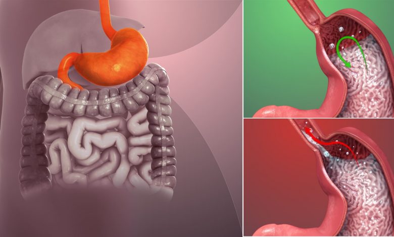 تجربتي مع العسل لعلاج ارتجاع المرئ
