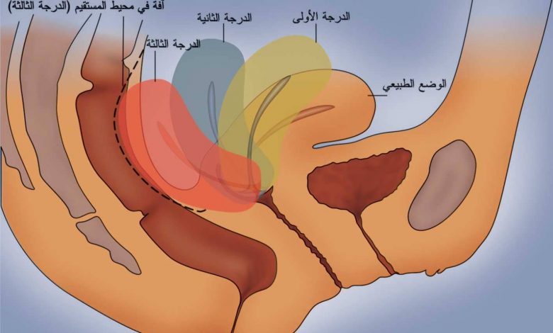 تجربتي لفتح الرحم وتسريع الطلق