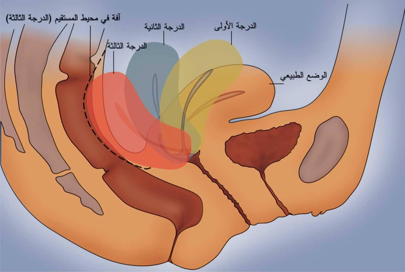 تجربتي لفتح الرحم وتسريع الطلق