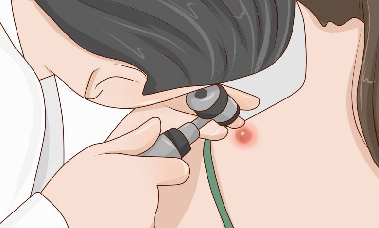 طرق علاج الدمامل والخراجات