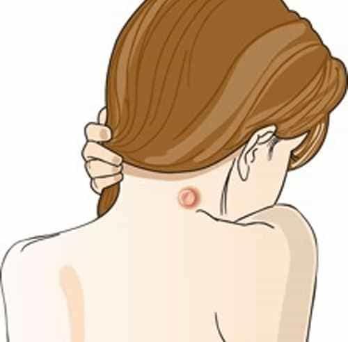 الحالات الأكثر احتمالية للإصابة بالخراج الحالات الأكثر احتمالية للإصابة بالخراج
