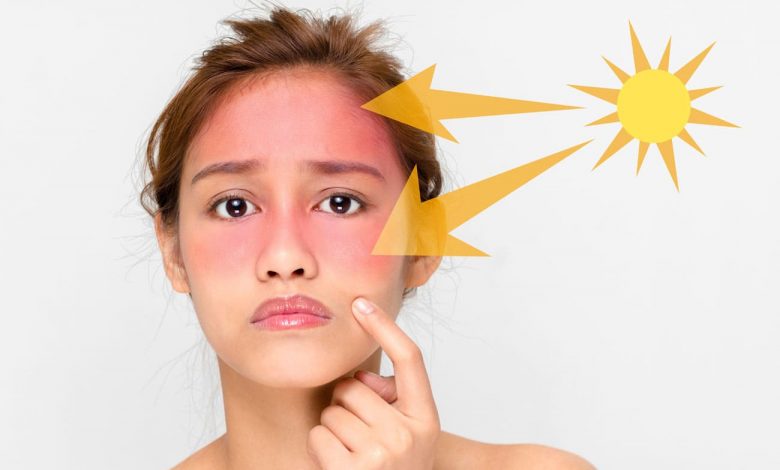 علاجات حروق الشمس المنزلية