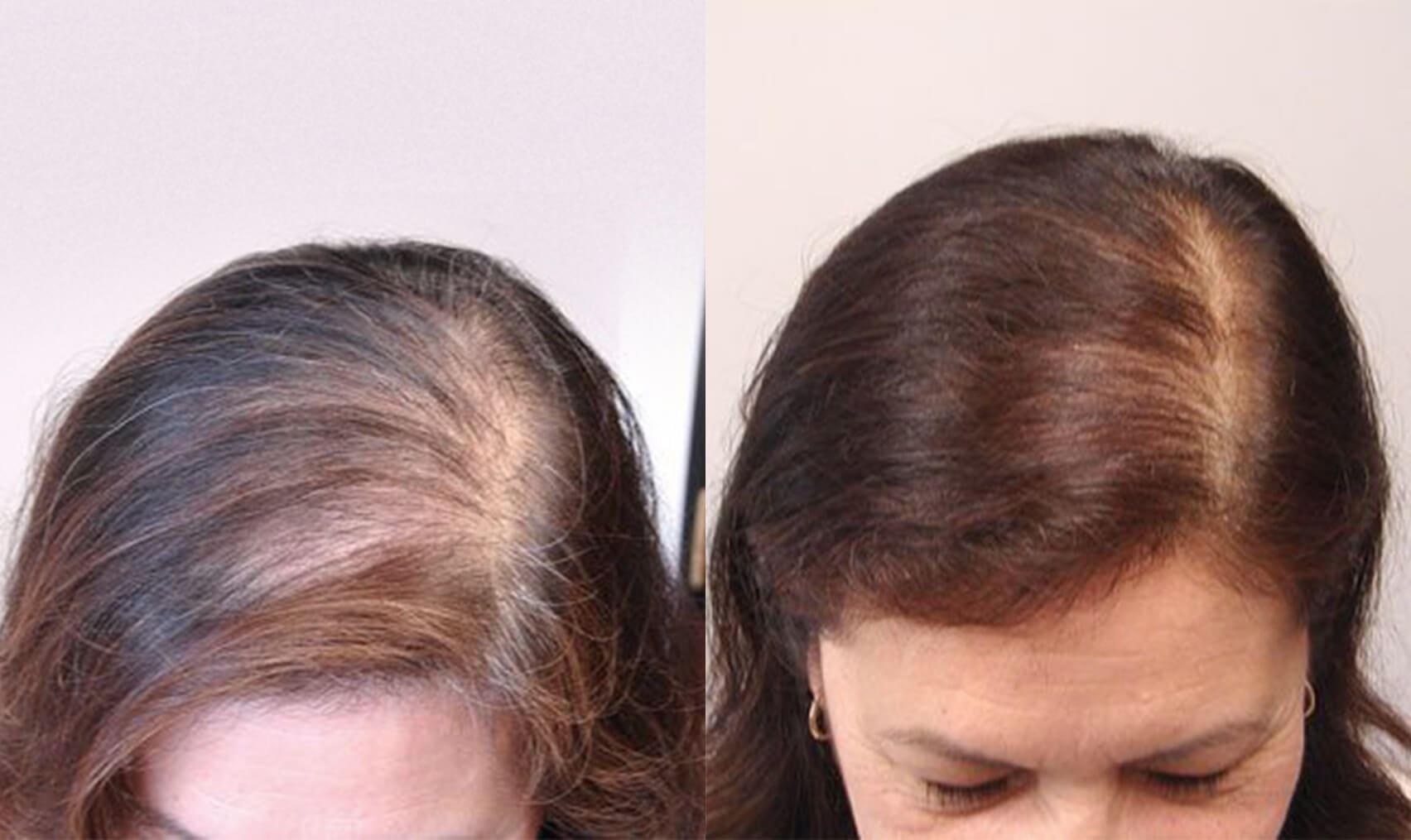 طرق علاج تساقط الشعر وأسبابة