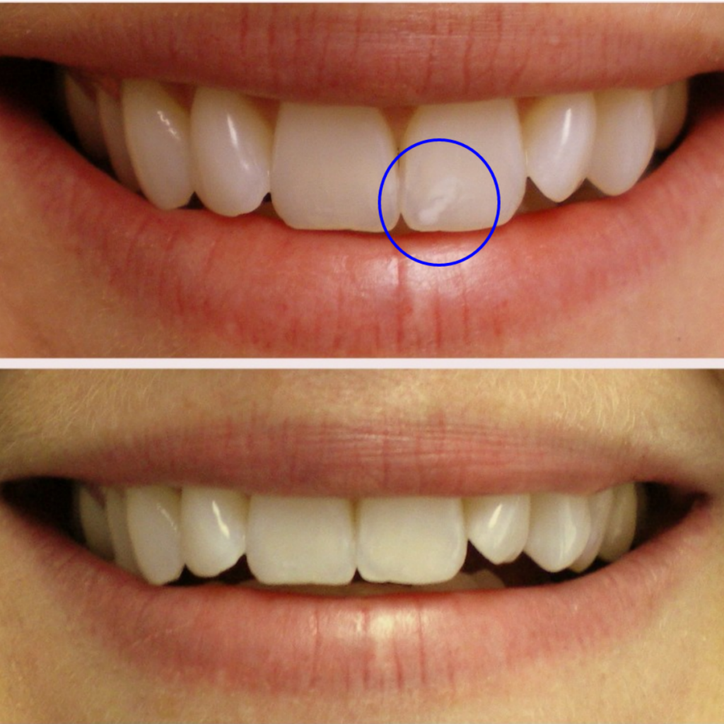 أنواع حشو الأسنان واسعارها