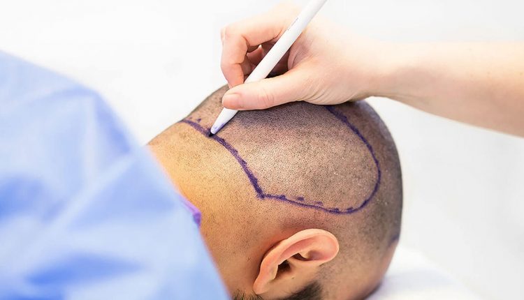 افضل اماكن زراعة الشعر فى مصر افضل اماكن زراعة الشعر فى مصر