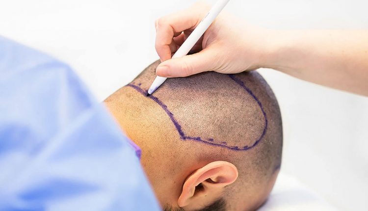 افضل اماكن زراعة الشعر فى مصر