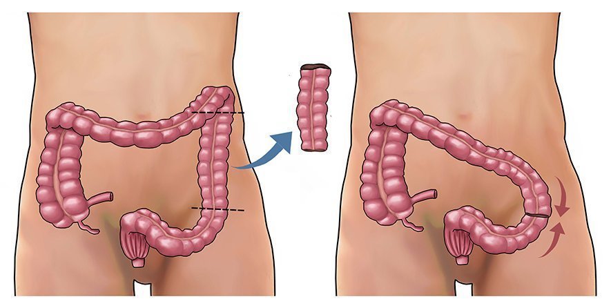 تجربتي مع استئصال القولون