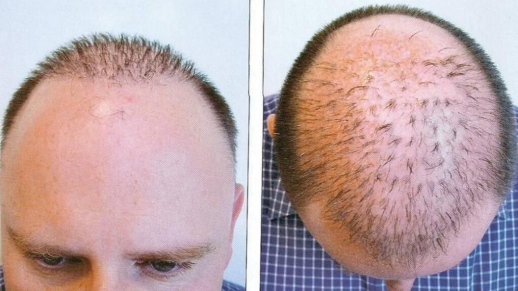 تكاليف زراعة الشعر في أبوظبي تكاليف زراعة الشعر في أبوظبي