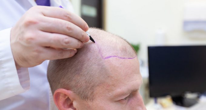 تكلفة زراعة الشعر في تركيا 2022 تكلفة زراعة الشعر في تركيا 2022