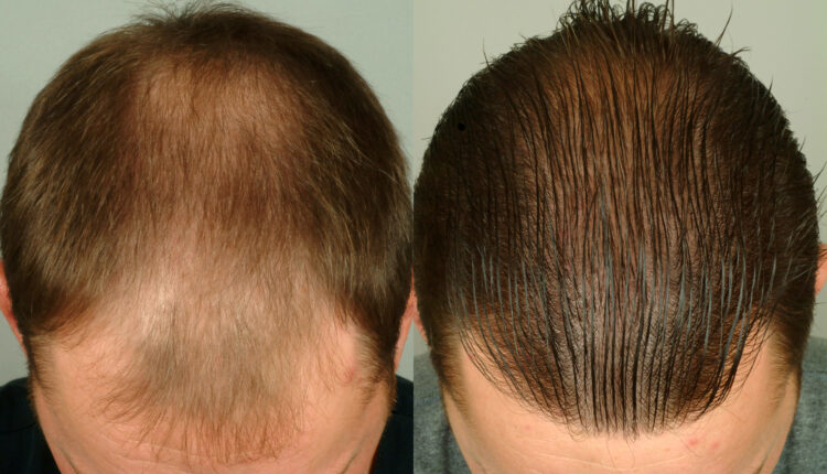 تجربتي مع زراعة الشعر في الرياض تجربتي مع زراعة الشعر في الرياض