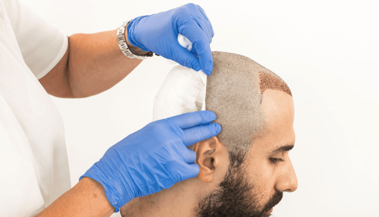 عملية زراعة الشعر في سلطنة عمان