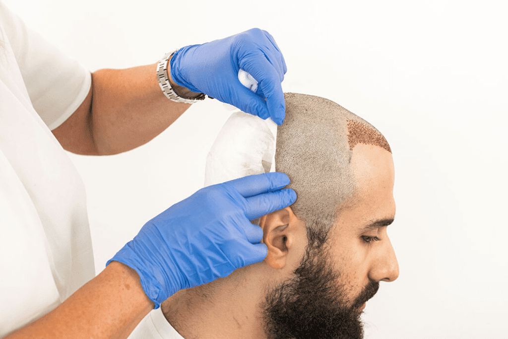 عملية زراعة الشعر في الإمارات