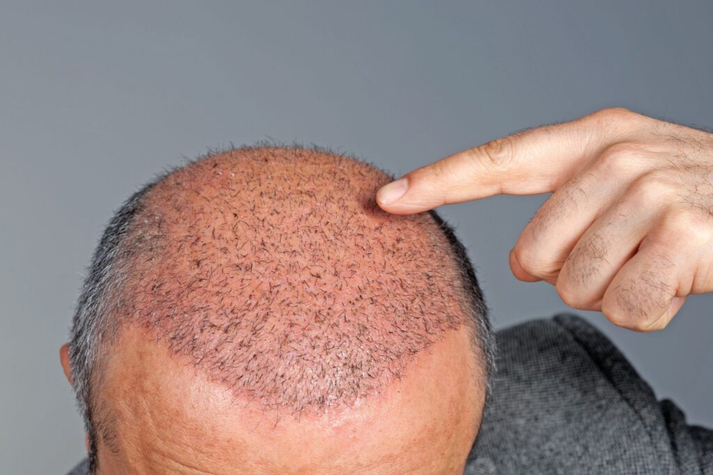 تكلفة زراعة الشعر في تركيا