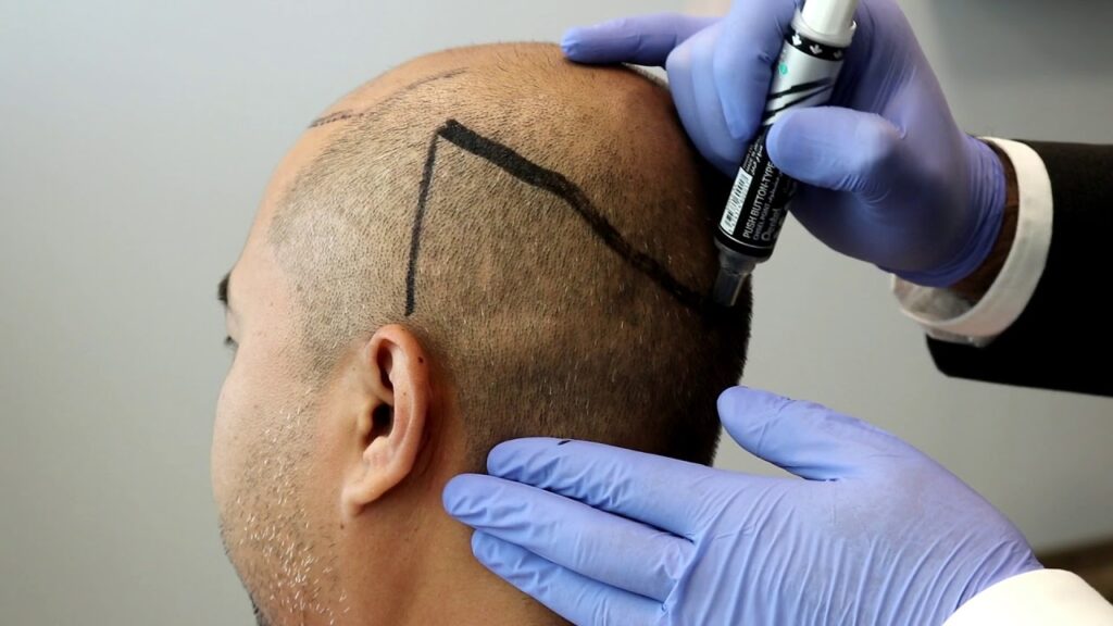 تكلفة زراعة الشعر في مصر 2022