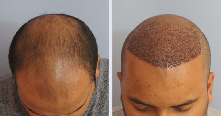تكلفة زراعة الشعر في تركيا بالريال السعودي تكلفة زراعة الشعر في تركيا بالريال السعودي