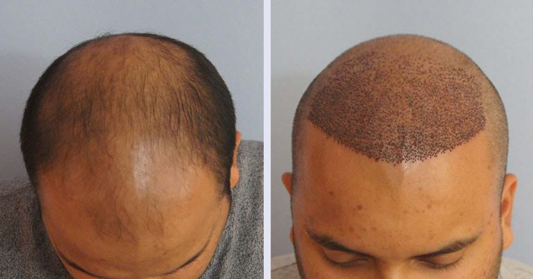 تكلفة زراعة الشعر في تركيا بالريال السعودي