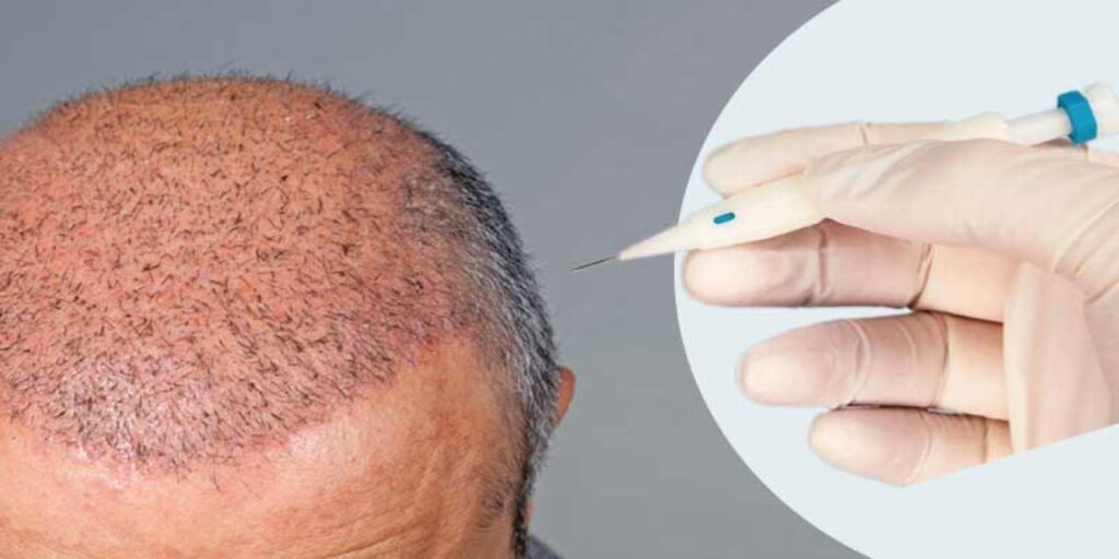 تجربتي في زراعة الشعر في دبي