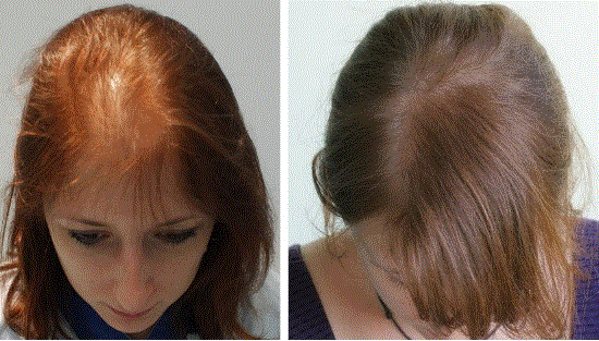 زراعة الشعر بالتقسيط في السعودية زراعة الشعر بالتقسيط في السعودية