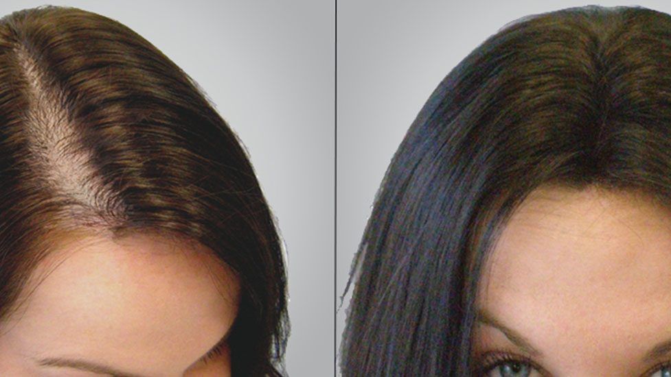 تجارب زراعة الشعر للنساء