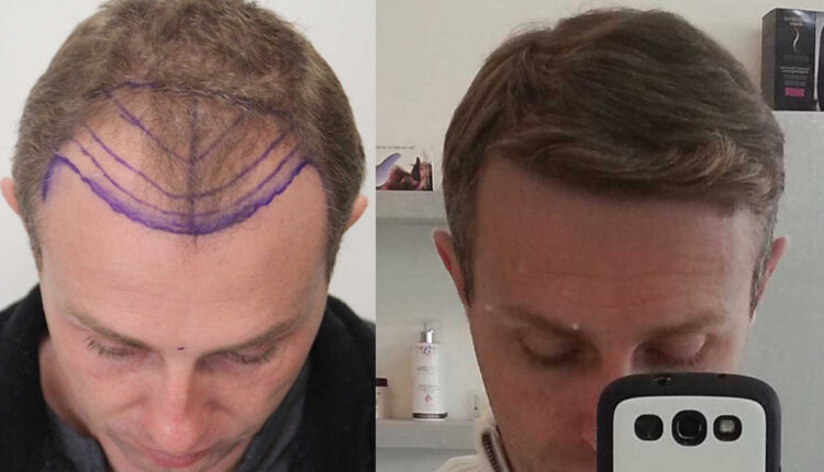 تكلفة زراعة الشعر في الأردن